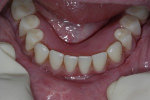3-overdenture-clips-on-top-of-implants1-300x199