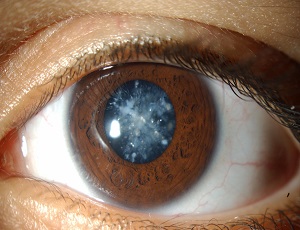 Глазные-капли-Калия-йодид-помогают-не-допустить-распространение-катаракты