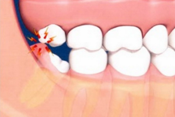 Показано, что воспаление возникает при прорезывании зуба