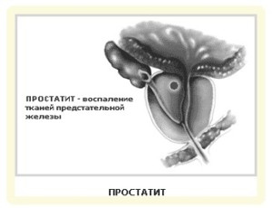 zabolevaniya-prostaty1-300x230