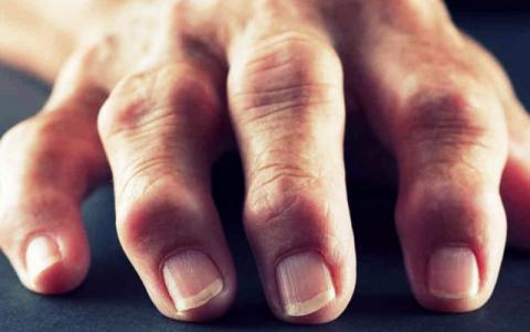 артрит-пальцев-рук