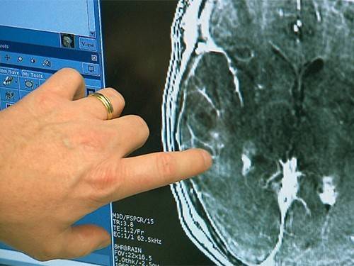 Ультразвуковая стимуляция головного мозга вывела пациента из комы