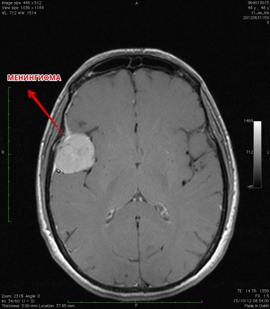 Объемное образования мозга мкб. Менингиома головного опухоль. Менингиома височной области мрт. Менингиома левой височной области. Опухоли мозга (менингиома);.