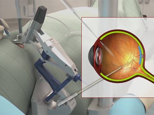 Робот провел операцию на глазу пациента