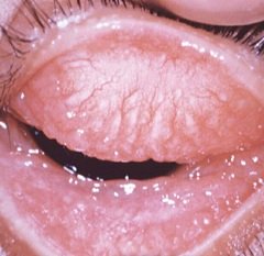 Тахома - инфекционное заболевание конъюнктивы глаз