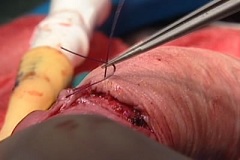Единственный метод лечения фимоза - операция