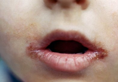 Симптомы хейлита на губах