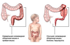 Симптомы развития болезни Гиршпрунга у ребенка