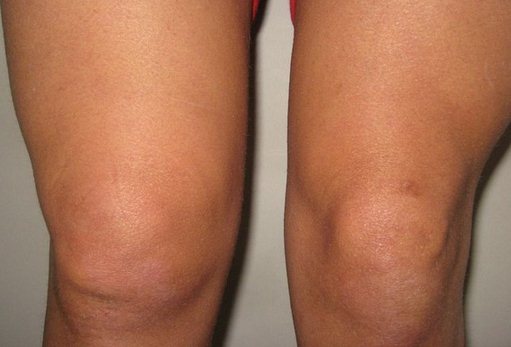 Гемартроз коленного сустава