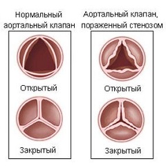 Аортальный стеноз - сужение просвета устья аорты из-за изменений клапана