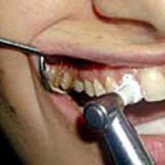 После проведения операции по удалению кисты зуба больному назначаются антибиотики