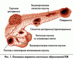 Виды кист поджелудочной железы