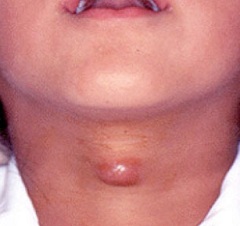 Киста щитовидной железы - узловое образование с полостью, заполненной жидкостью