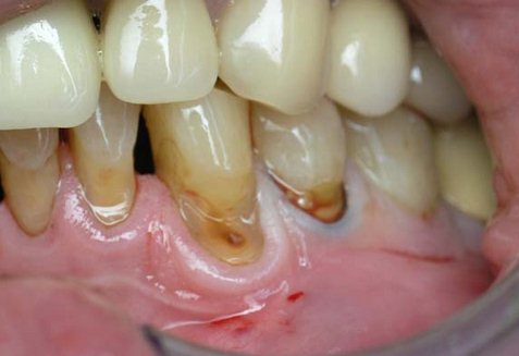 Клиновидный дефект зубов