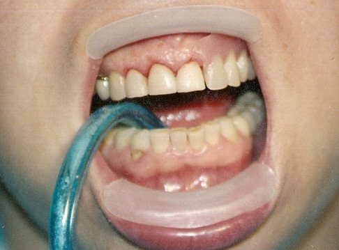 Лечение клиновидного дефекта зуюов