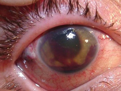 Симптомы контузии глаза