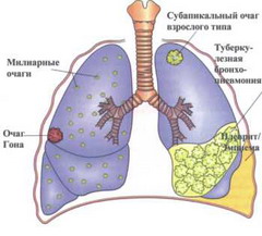 Милиарный туберкулез у больных пожилого и старческого возраста