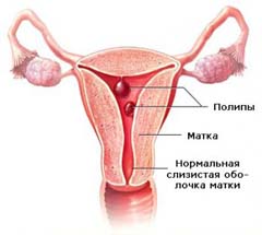 Симптомы полипов шейки матки