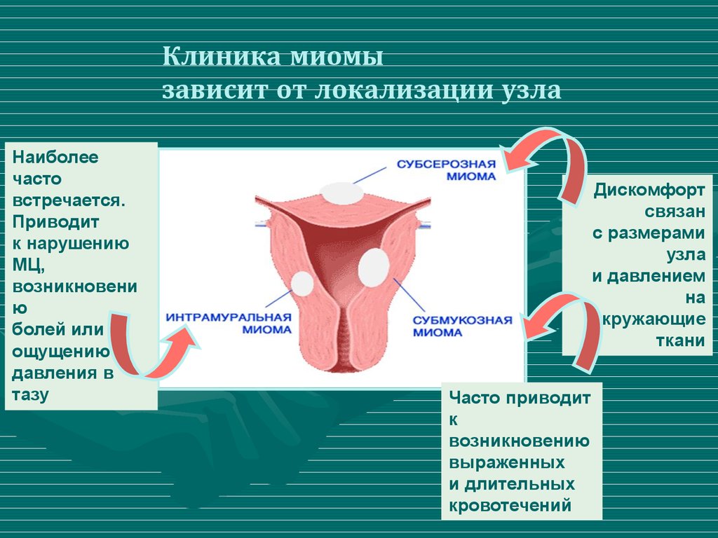 Что такое миома. Клинические проявления лейомиомы матки. Локализация миомы матки.